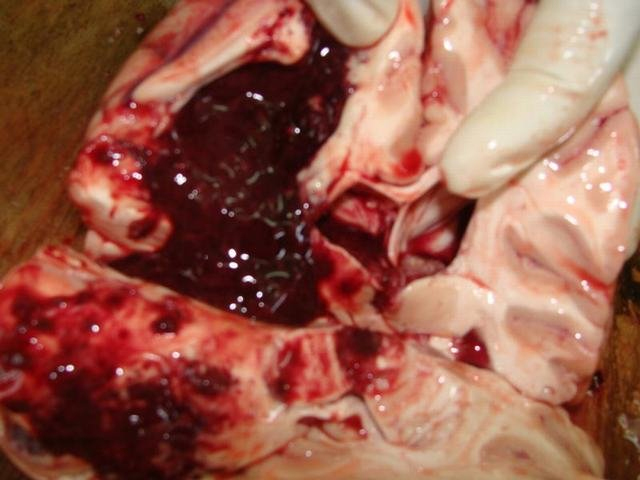 intracerebral hemorrhage